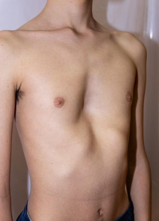 chest wall deformity